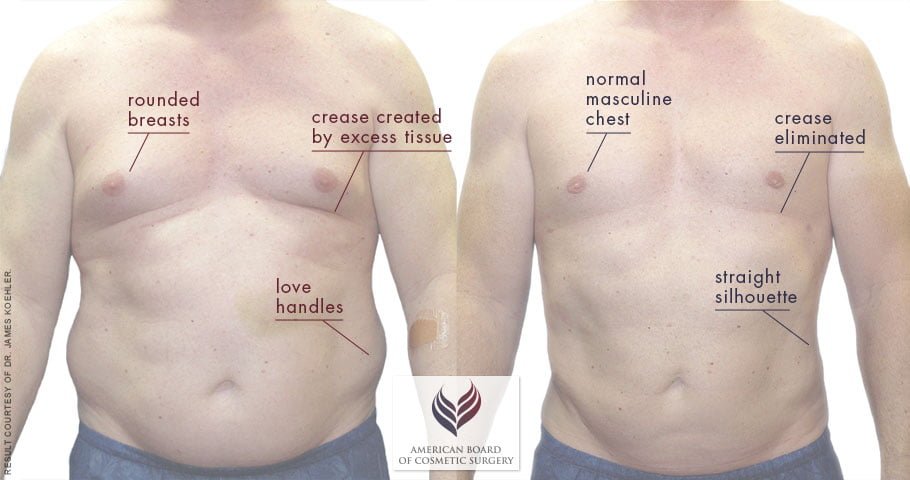 Patient before and after male breast reduction 