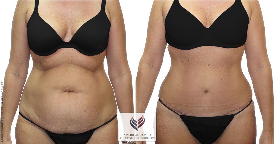 Tummy Tuck 7