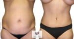 abcs-tummy-tuck-05a-pancholi