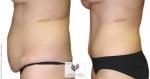 abcs-tummy-tuck-05c-pancholi