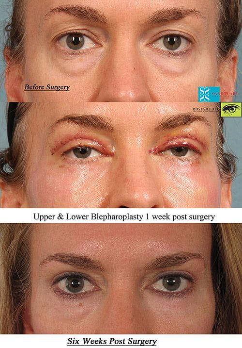 Types Of Eyelid Surgery And The Essential Checklist For Getting It Done Abcs