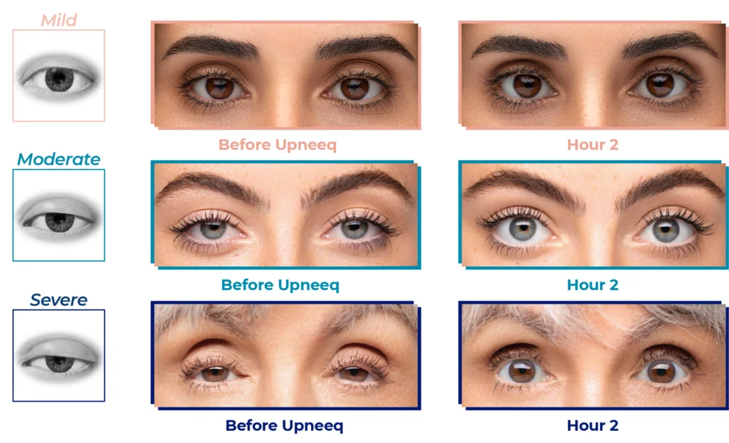 Lids By Design - the temporary non-surgical eyelid lift - Aesthetic Medical  Practitioner