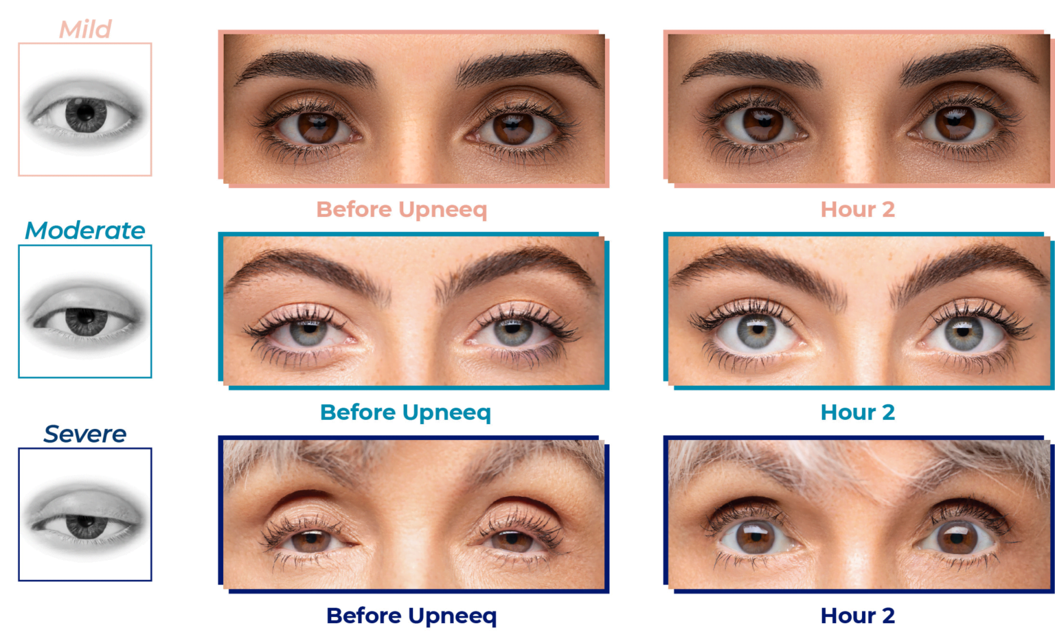 what-you-need-to-know-about-upneeq-the-fda-approved-eyelid-lifting