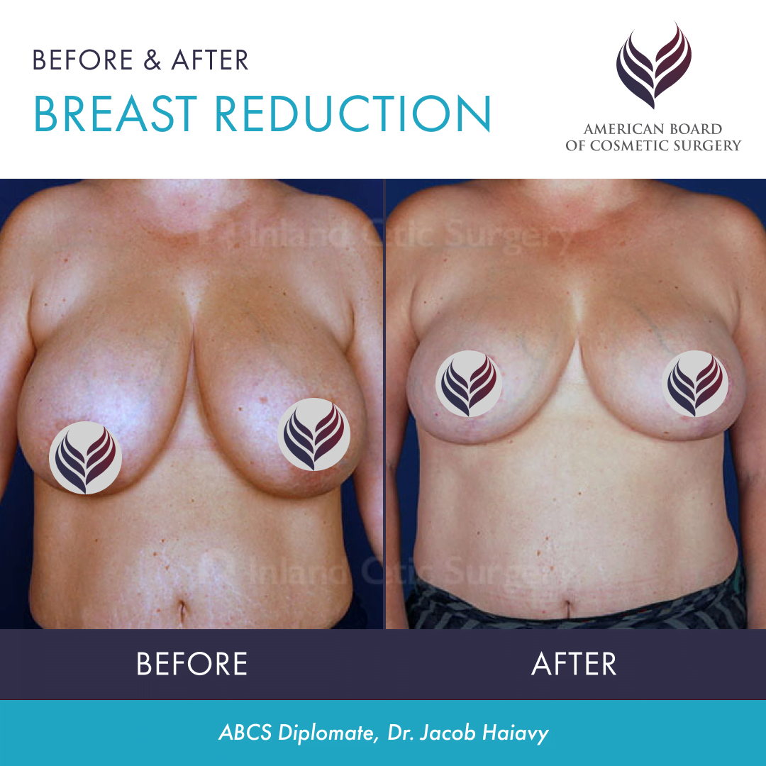 Tips for Getting the Most Out of Breast Before & After Photos - ABCS