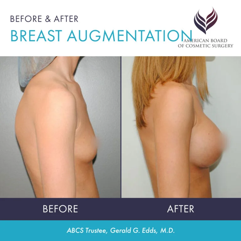 breast augmentation/ba before & after (almost 3 wks po) : r
