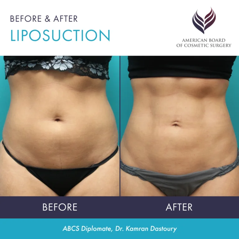 Liposuction  Patient Guide - The American Board of Cosmetic Surgery