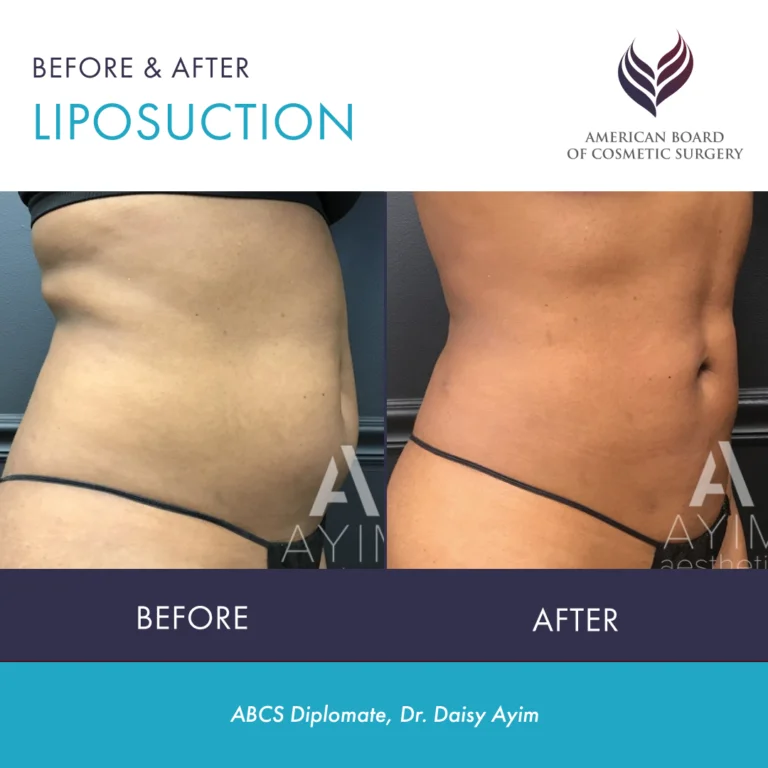 4 Types Of Liposuction: Allow Your Body The Opportunity To Look