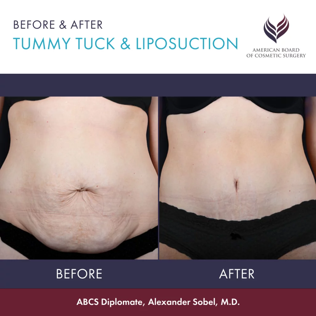 Tummy Tuck  Abdominoplasty 🙌 Do you want your tummy tuck to