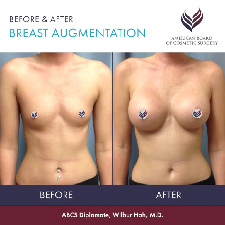 Breast Augmentation (Breast Implants)