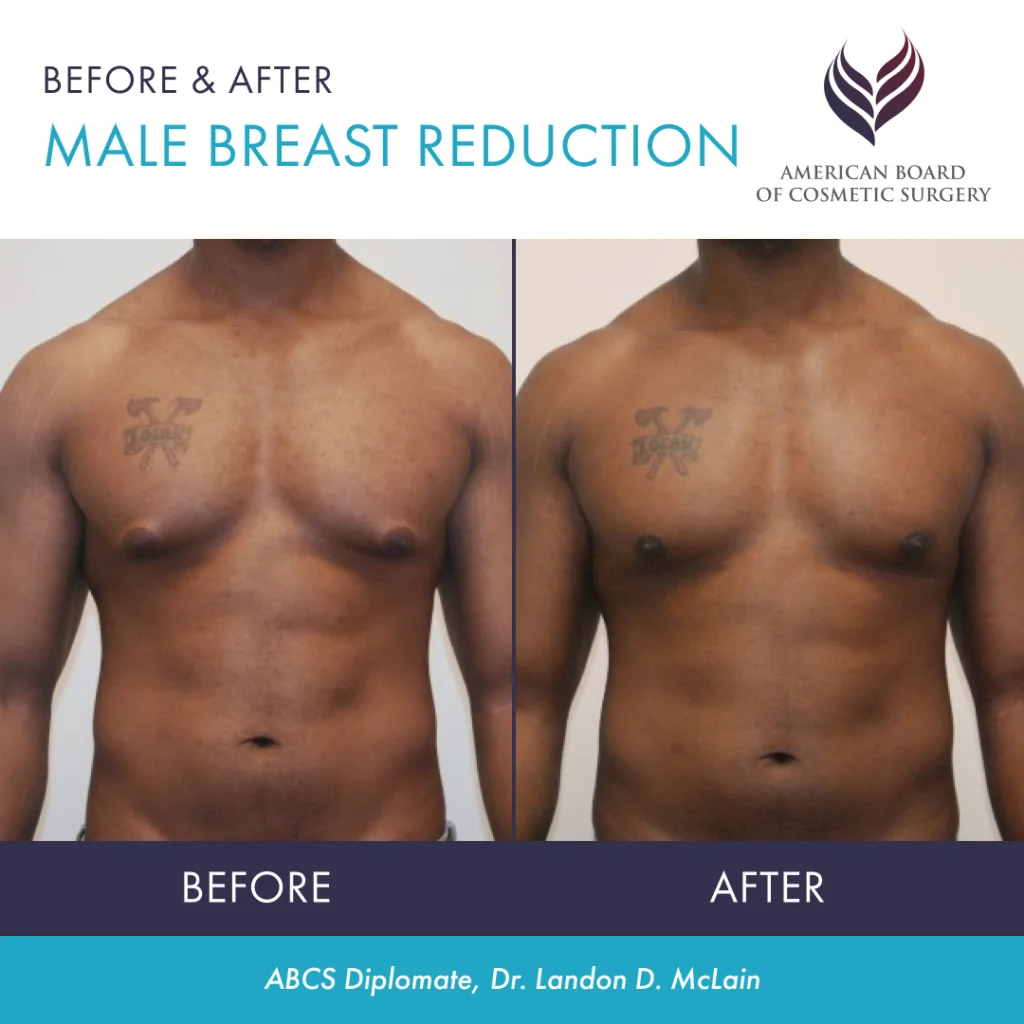 Male Breast Reduction Guide Gynecomastia Surgery Guide ABCS