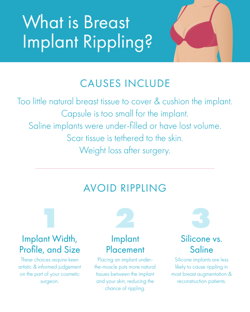 Breast implant rippling infographic