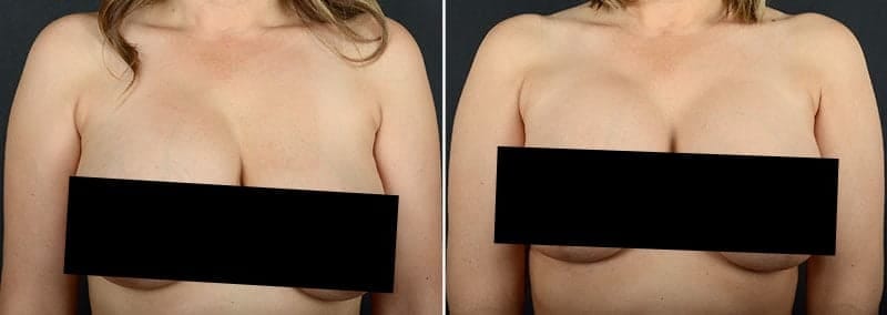 Before and after breast surgery revision after a rupture with Dr. Alex Sobel in Seattle