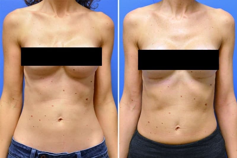 Before and after breast implant revision with Dr. Rhys Branman in Little Rock