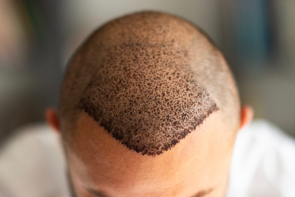 Faceless man's scalp after a hair transplant procedure