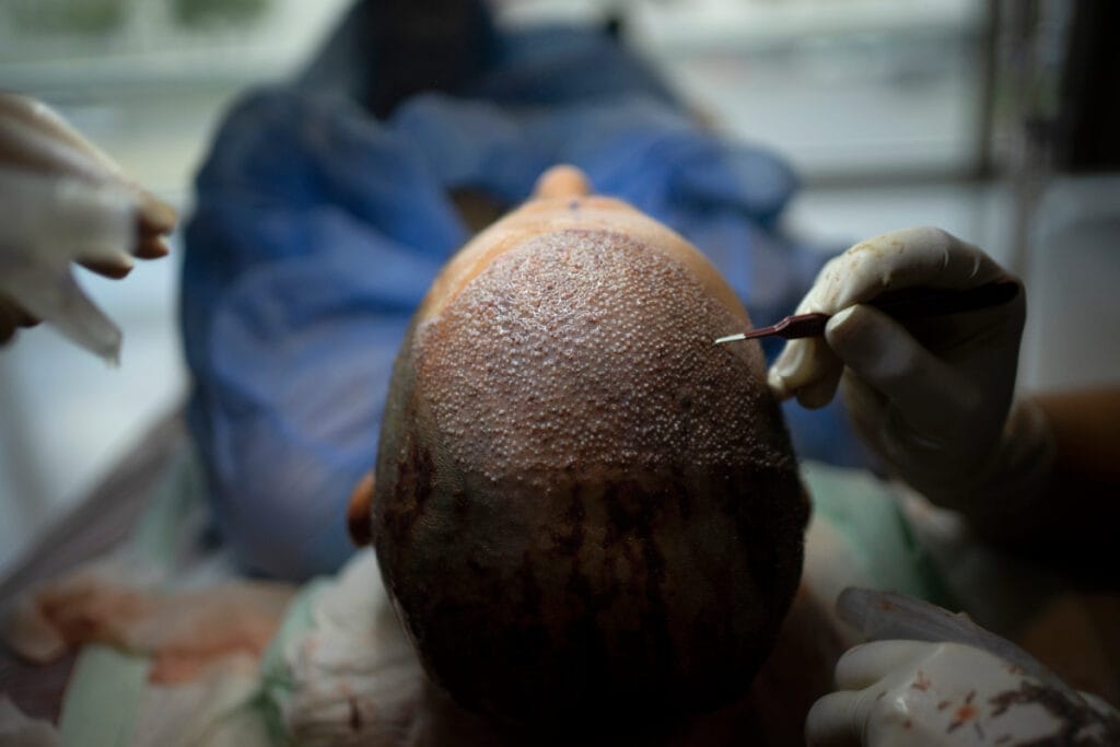 Man's scalp during hair transplant procedure